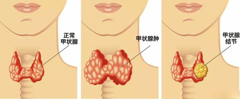 甲状腺结节