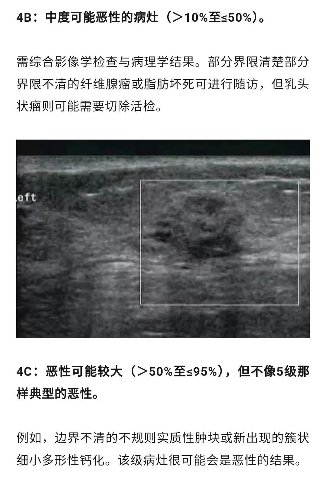 乳腺结节恶性的可能性有多大？一文读懂乳腺结节BI-RADS分级标准！