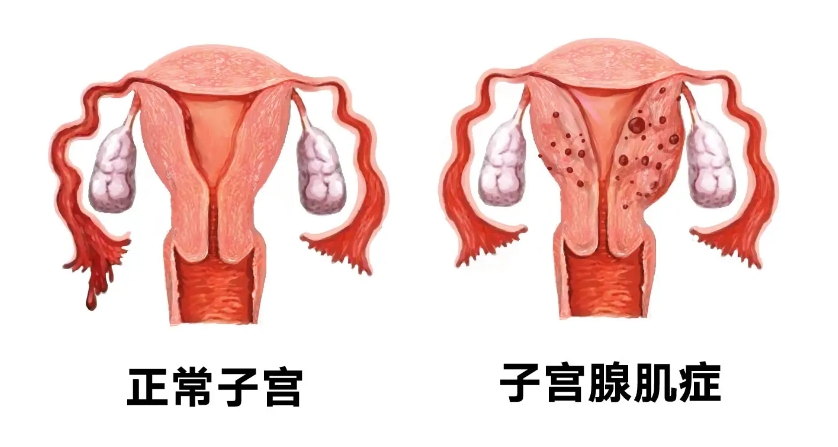 子宫腺肌症